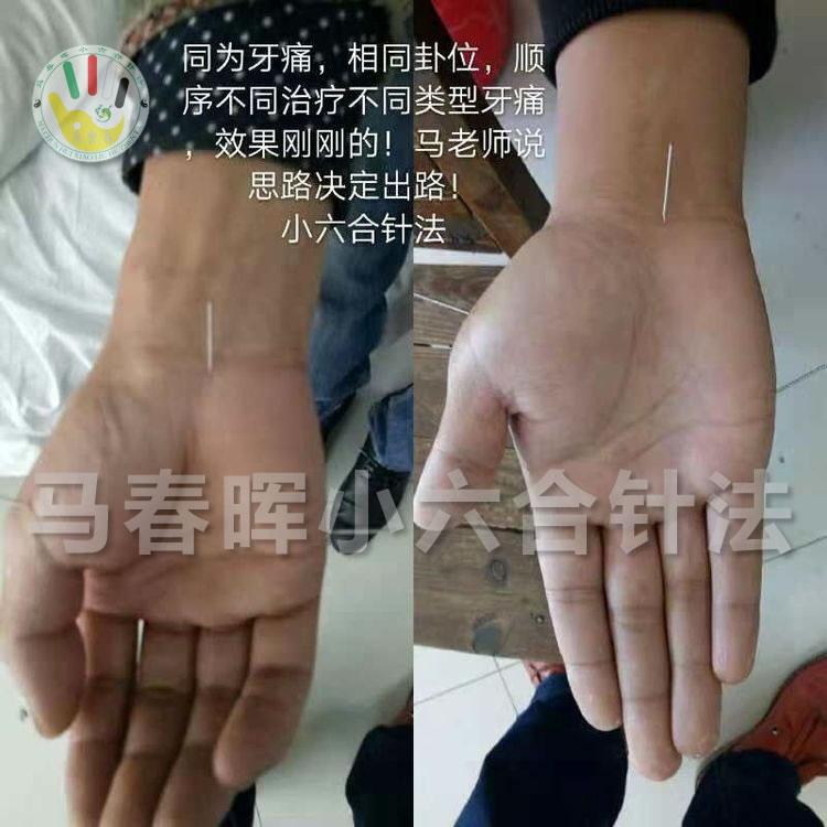 马春晖小六合针法组方思路