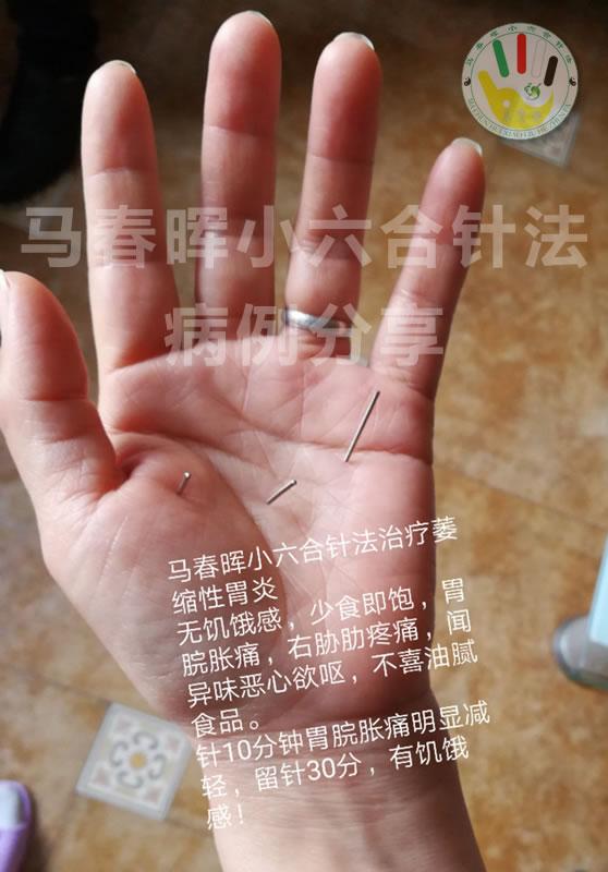 马春晖·小六合针法治疗【萎缩性胃炎】病例